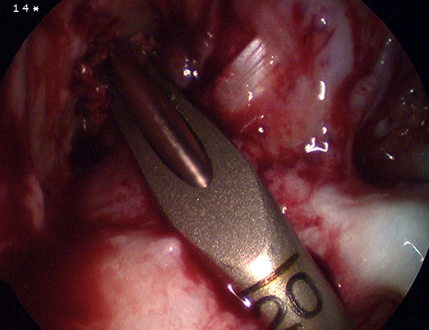 ACL Transtibial Beath Pin 1